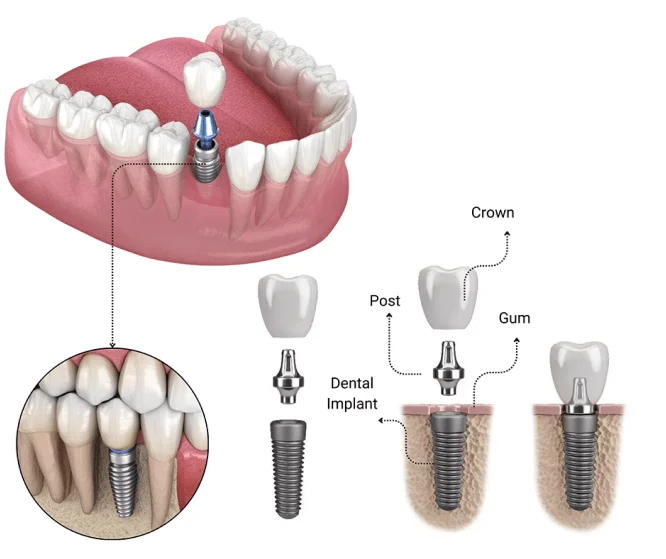 single tooth implant 1 min